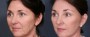 Dr. Roark Facelift Patient 4