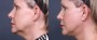Dr. Roark Neck Lift Patient 2