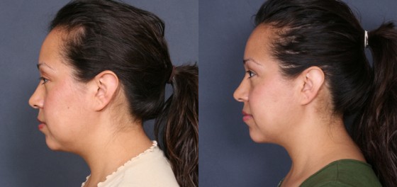 HMR-Liposuction-1-2