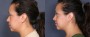 Dr. Roark Neck Liposuction Patient 1