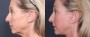 Dr. Roark Facelift Patient 1