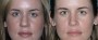 Dr. Grzeskiewicz Rhinoplasty Patient 2