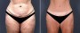 Dr. Saltz Tummy Tuck Patient 2