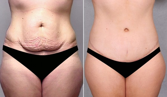 abdominoplasty-568280a-saltz