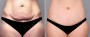 Dr. Saltz Tummy Tuck Patient 3
