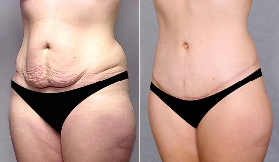 abdominoplasty-568280b-saltz