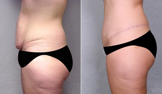 abdominoplasty-568280c-saltz