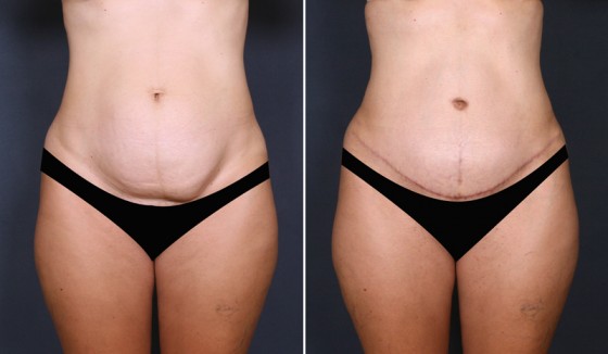 abdominoplasty-575848-a-saltz