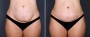 Dr. Saltz Tummy Tuck Patient 4