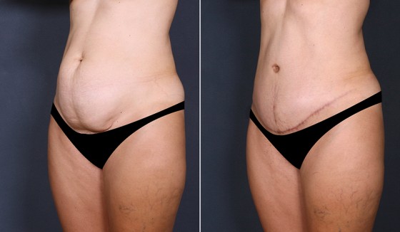abdominoplasty-575848-b-saltz