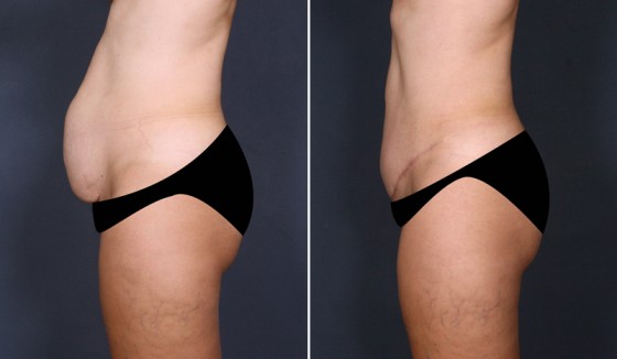 abdominoplasty-575848-c-saltz