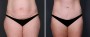 Dr. Saltz Tummy Tuck Patient 5