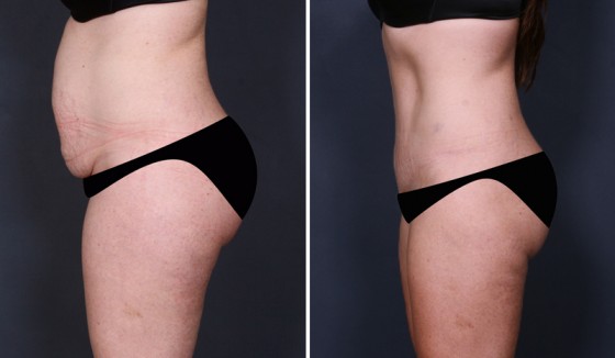 before and after tummy tuck photo