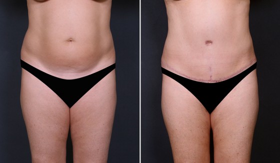abdominoplasty-577525-a-saltz