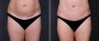 Dr. Saltz Tummy Tuck Patient 6