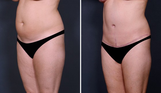 abdominoplasty-577525-b-saltz