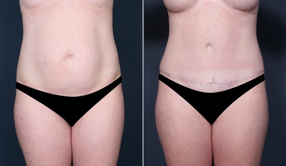 abdominoplasty-578630-a-saltz