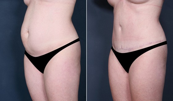 abdominoplasty-578630-b-saltz