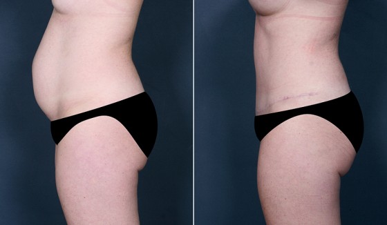 abdominoplasty-578630-c-saltz