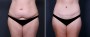 Dr. Saltz Tummy Tuck Patient 7