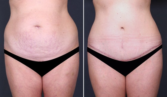 abdominoplasty-943123-a-saltz