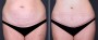 Dr. Saltz Tummy Tuck Patient 8