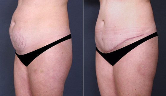 abdominoplasty-943123-b-saltz
