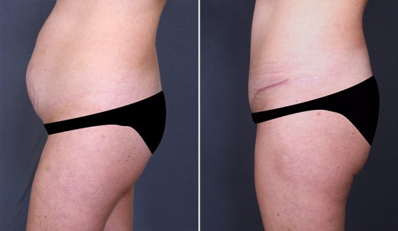 abdominoplasty-943123-c-saltz