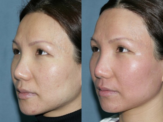 acnescars2.2
