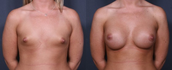 brahme-breast-aug-31a