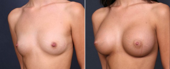 dr-brahme-breast-augmentation-03b