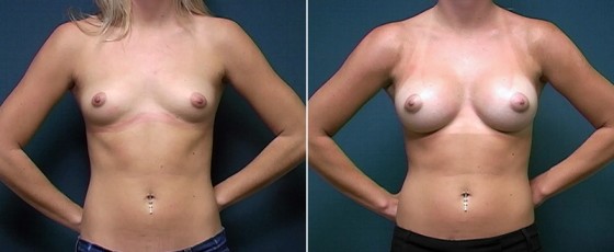 dr-brahme-breast-augmentation-05a