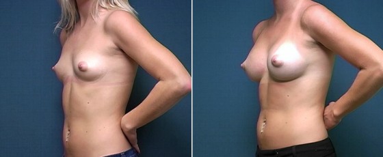 dr-brahme-breast-augmentation-05b