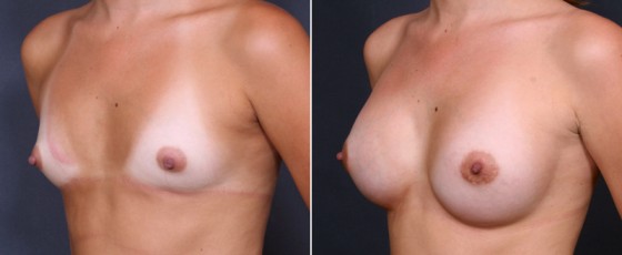 dr-brahme-breast-augmentation-07b