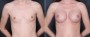 Dr. Brahme Breast Augmentation Patient 12