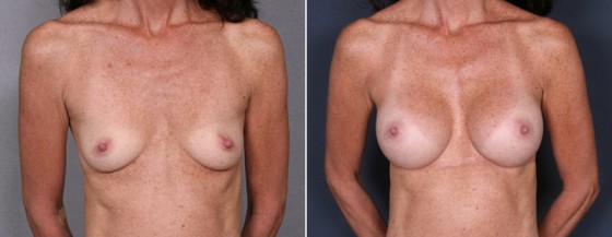 dr-brahme-breast-augmentation-15a