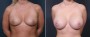 Dr. Brahme Breast Augmentation Patient 14