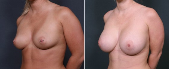 dr-brahme-breast-augmentation-16b