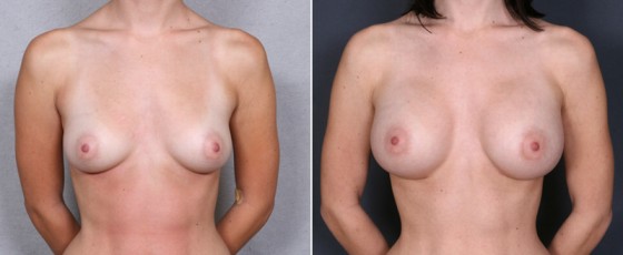 dr-brahme-breast-augmentation-17a