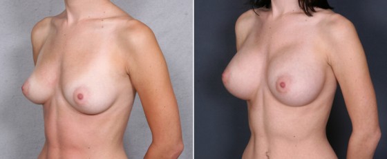 dr-brahme-breast-augmentation-17b