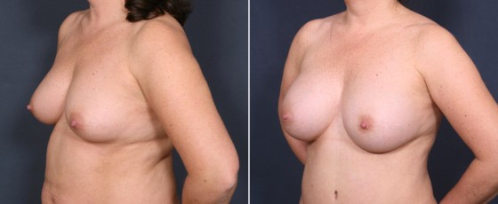 dr-brahme-breast-augmentation-18b
