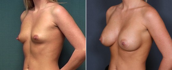 dr-brahme-breast-augmentation-23b