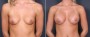 Dr. Brahme Breast Augmentation Patient 21