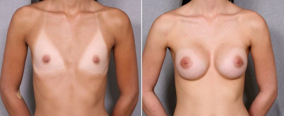 dr-brahme-breast-augmentation-25a