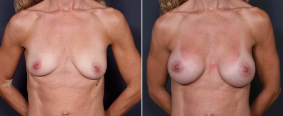 dr-brahme-breast-augmentation-26a