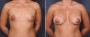 Dr. Brahme Breast Augmentation Patient 25