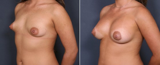 dr-brahme-breast-augmentation-28b