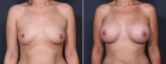dr-brahme-breast-augmentation-29a