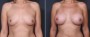 Dr. Brahme Breast Augmentation Patient 26