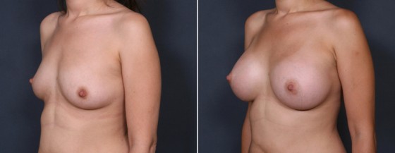dr-brahme-breast-augmentation-29b